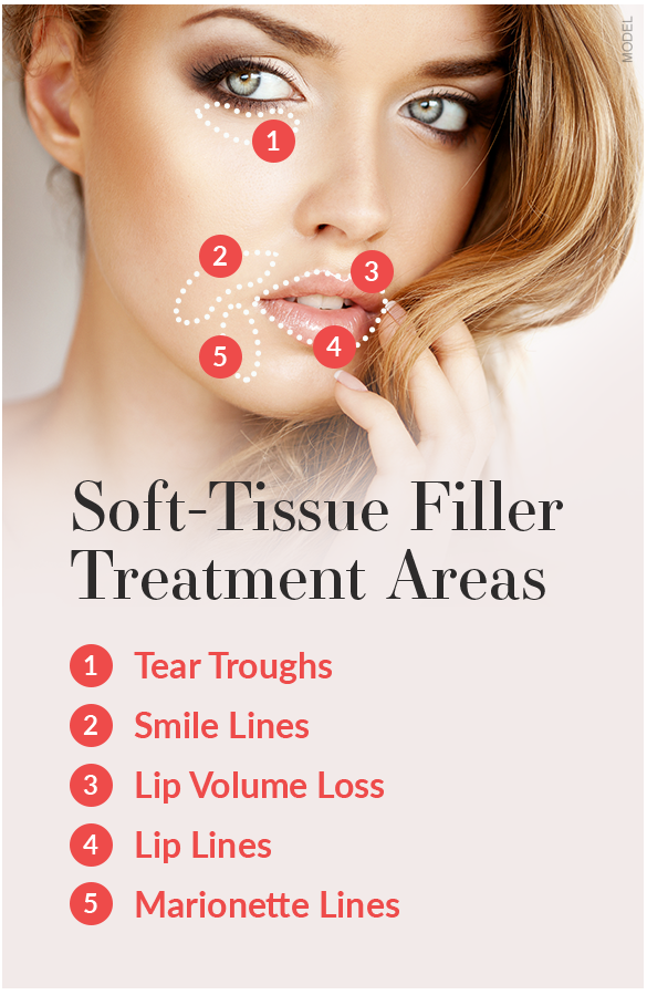 Graphic featuring woman's face and soft tissue filler treatment areas