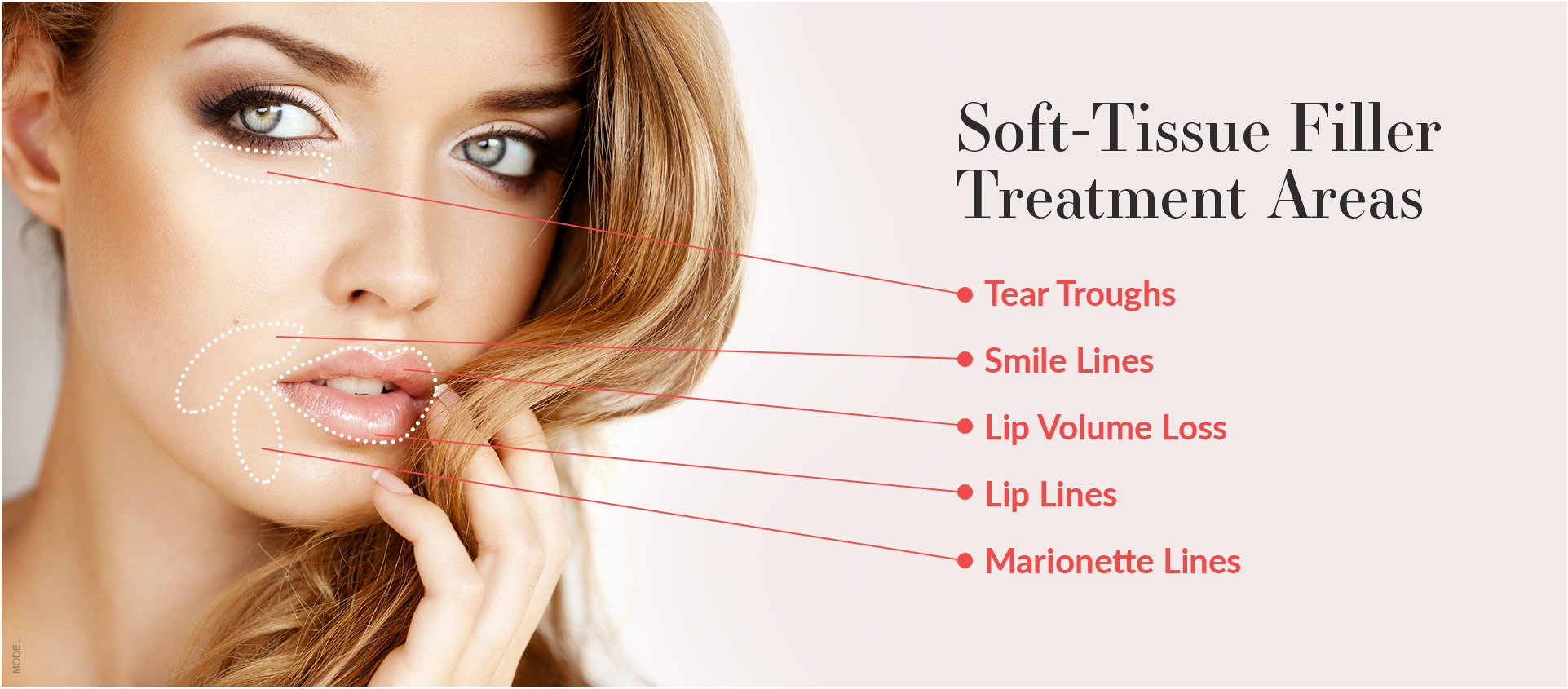 Graphic featuring woman's face and soft tissue filler treatment areas