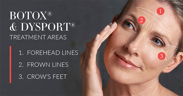 Graphic featuring woman and Botox treatment areas
