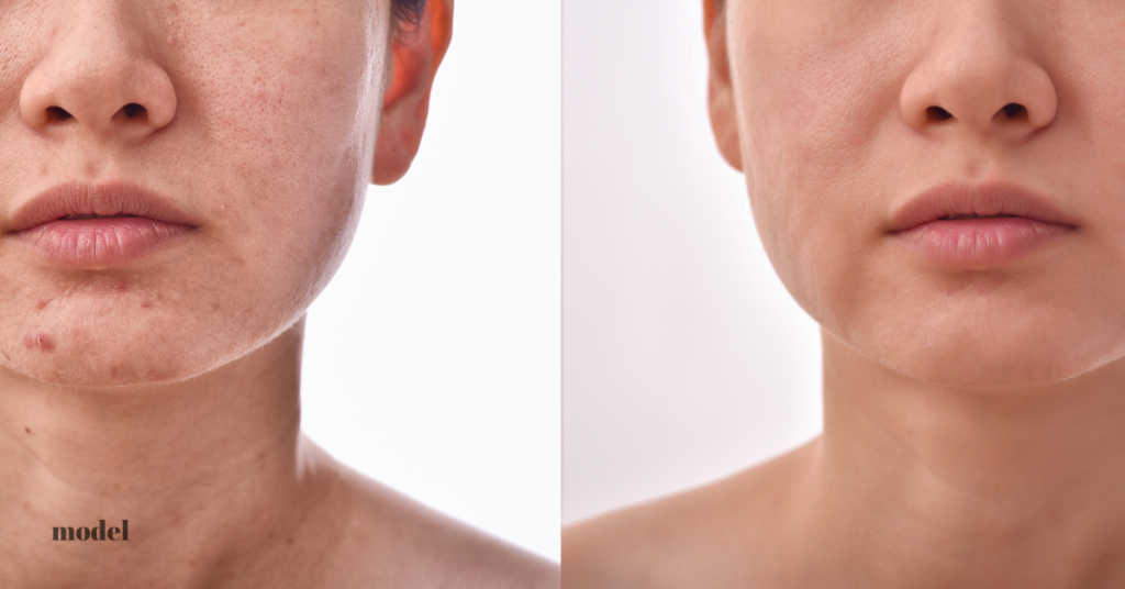 a before and after image of a woman who had a skin rejuvenation procedure (model)